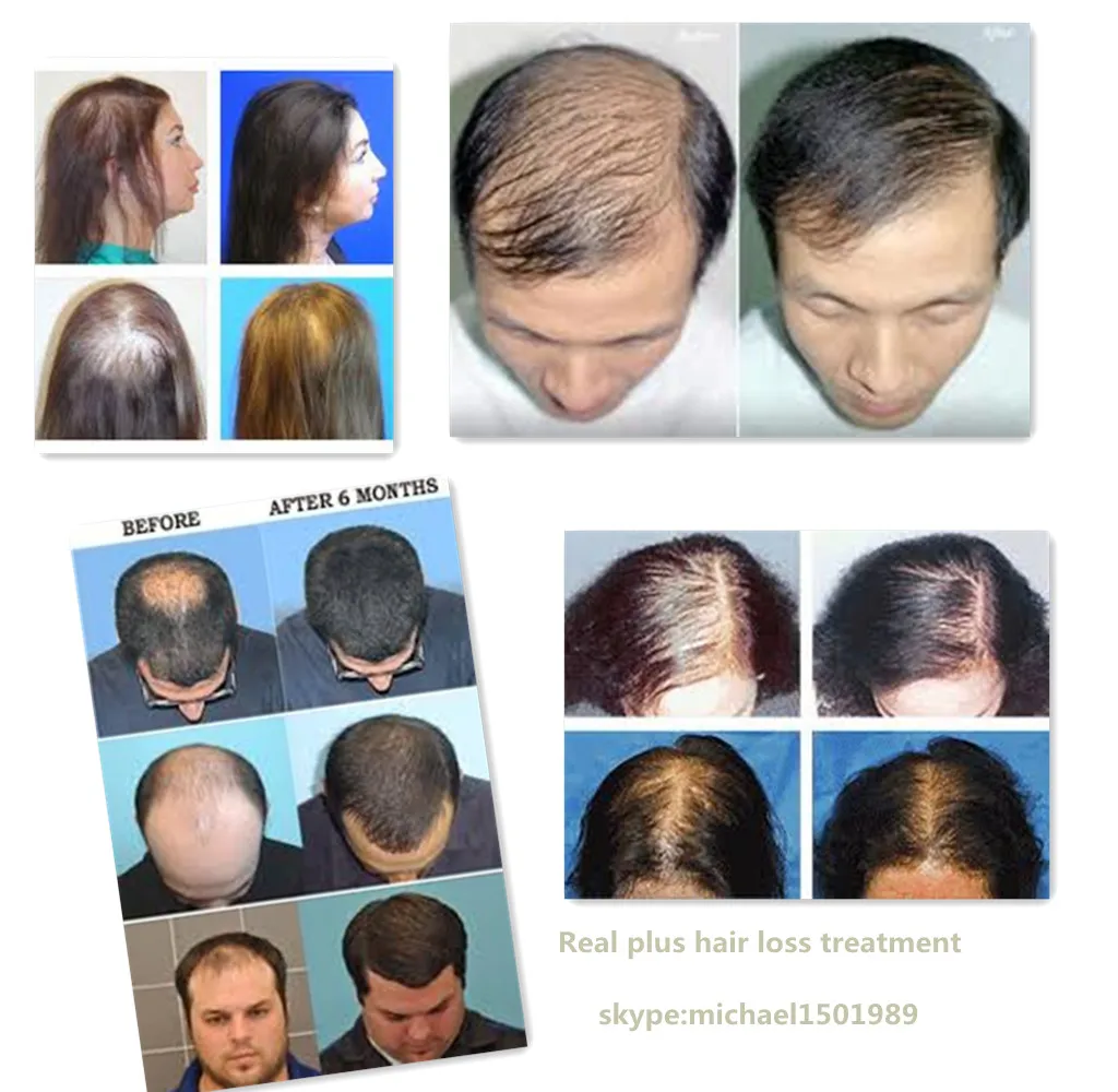 Strong Version Anti Hair Loss Treatment The Best Hair Oil For