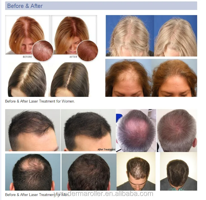 Yyr 80 Laser Hair Regrowth Helmet Hair Loss How To Regrow Hair