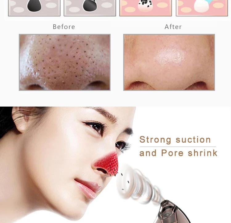 vacuum blackhead remover