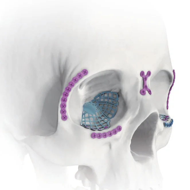 Орбитальная кость. Титановые сетки для хирургии. Пластины Maxillofacial Plate. Титановая пластина хирургическая. Титановая сетка для орбиты.