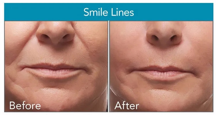 Cosmetic Surgery Skin Rejuvenate Hyaluronic Acid Filler For Wrinkles 