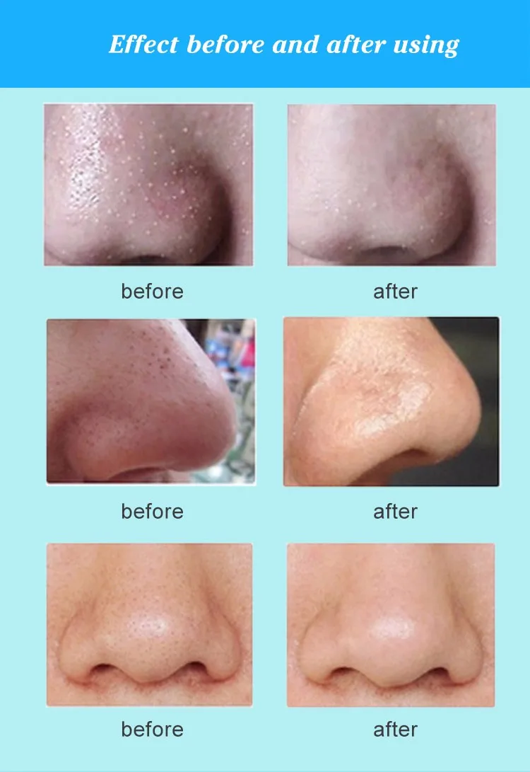 exfoliate dead skin
