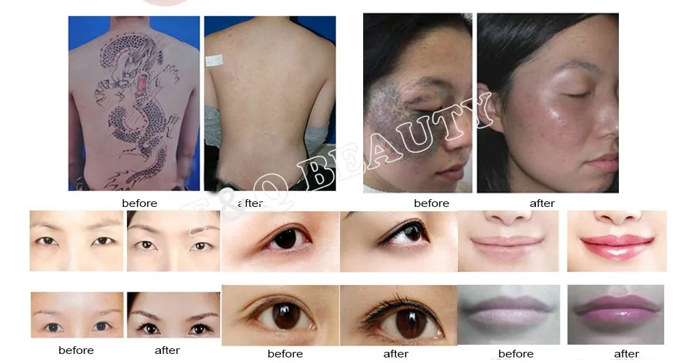 Nd Yag laser tattoo eyebrow removal machine