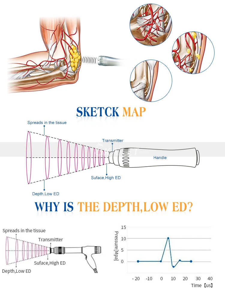 最佳折扣 sw9 zimmer 冲击波勃起功能障碍疼痛缓解与 ce