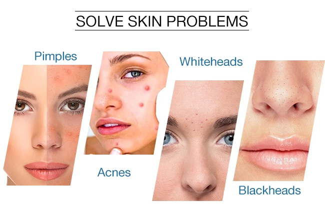 best retinol serum for blackheads