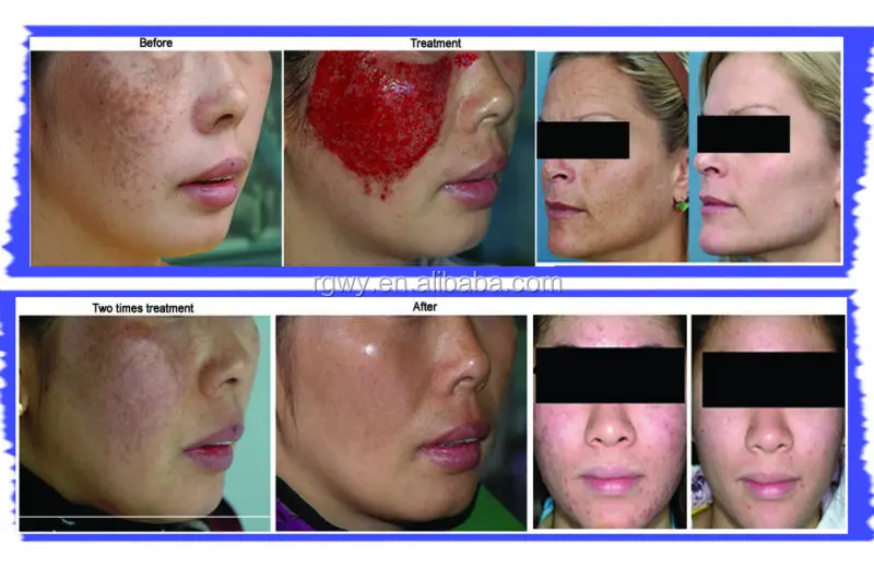 birthmark removal.jpg