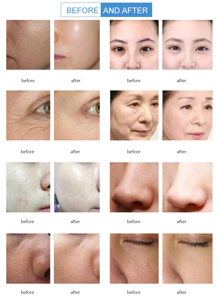 Multifunction Facial skin care hydra beauty Machine/Super aqua dermabrasion hydro water oxygen hydrogen Jet Peel