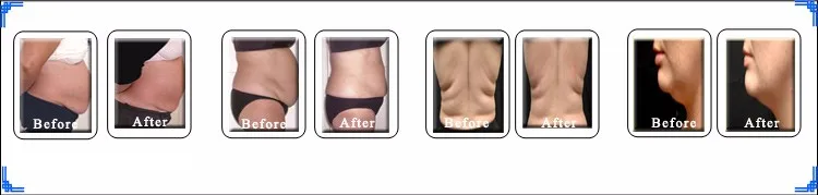 Save More!!! Portable 6 in 1 various function for your option with lipo slimming Cavitation shape Rf lifting.jpg