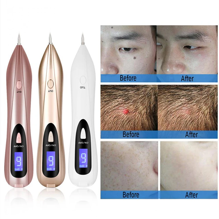 Plasma Pen Mole Remover / Acupuncture Beauty Medical Plasma Pen Korea ...