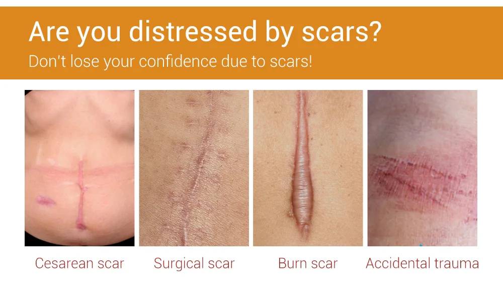 LANBENA scar removal serum stretch mark remover