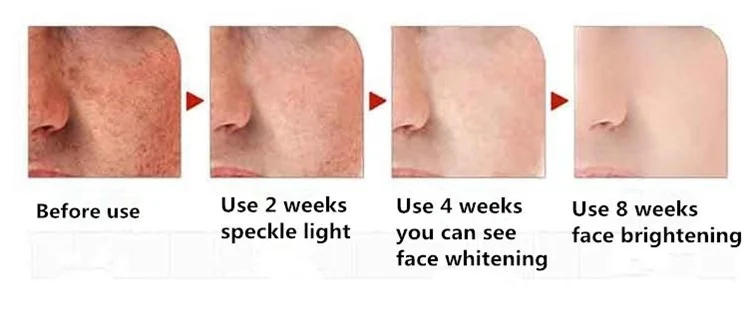 cream for hyperpigmentation on neck