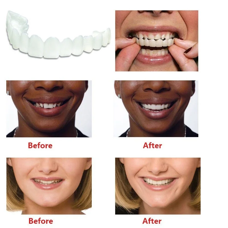 Temporary Tooth Kit Braces Instant Veneers Dentures For Smile