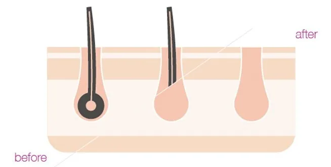 cosbeauty at home permanent commercial 808nm diode laser ipl back body hair removal machine/device price