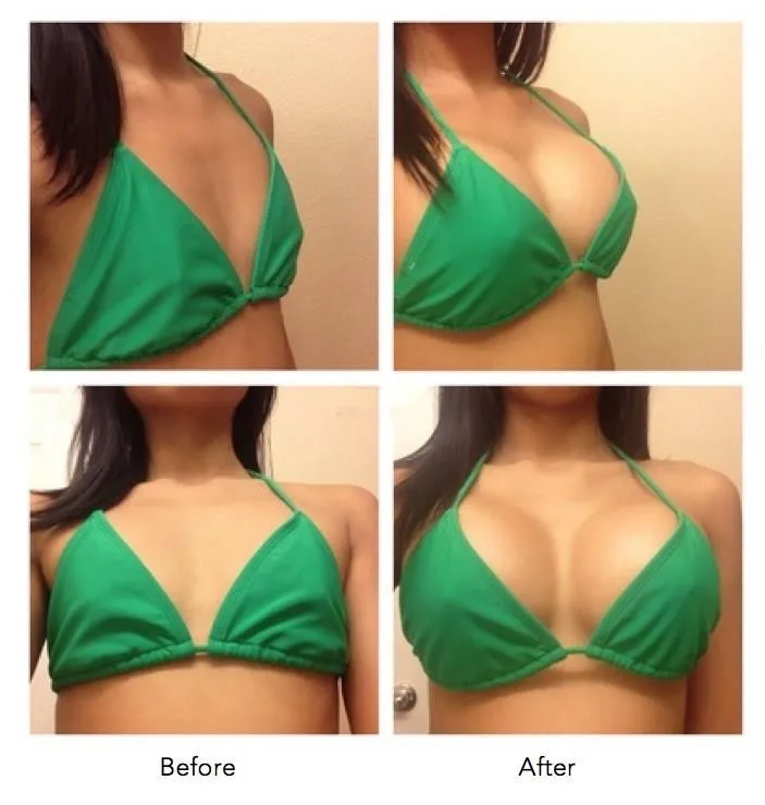 Hyaluronic Acid Injection for Breast Augmentation.