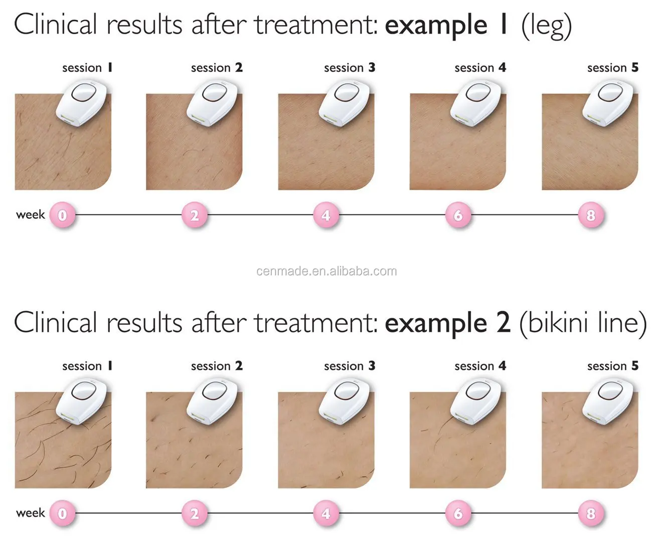 IPL treatment