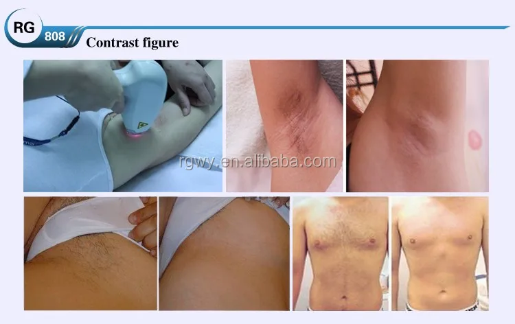 808nm diode laser hair removal