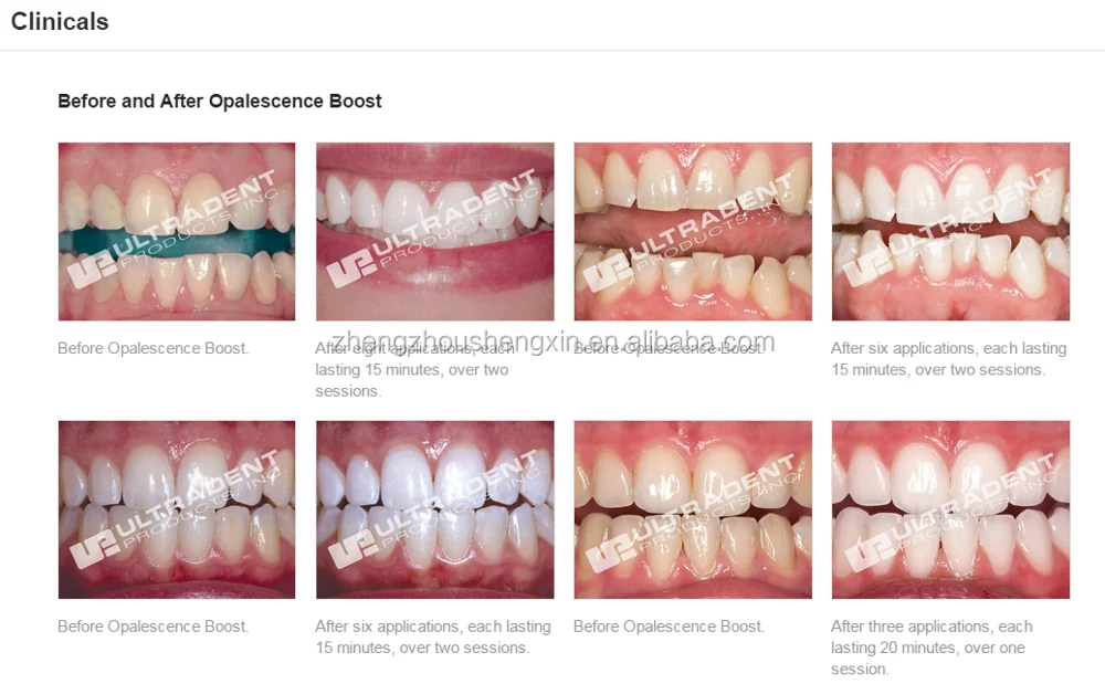 opalescence boost отбеливание зубов отзывы