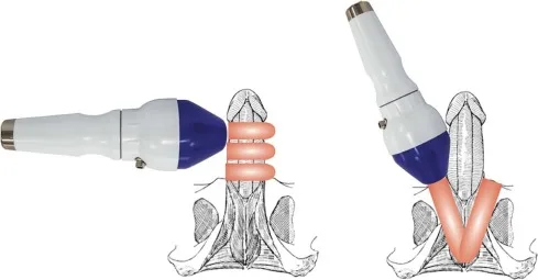 Unfocused BS-SWT2X ED shock wave ed therapy penis enlargement machine male