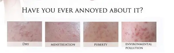 Bioaqua face cream anti acne treatment cream oil control Moisturizing Acne Scar Remover Pores acne cream