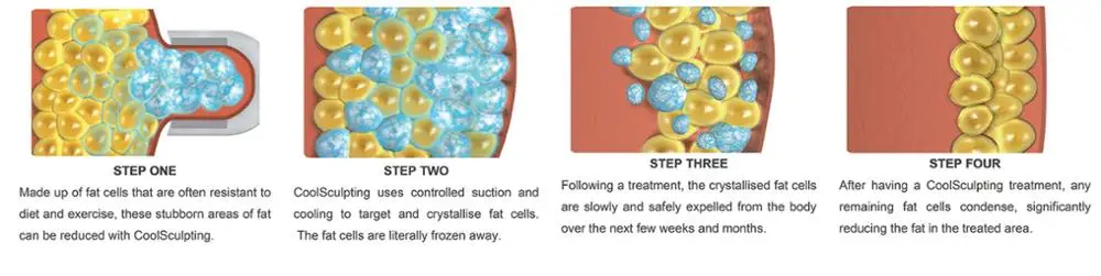 Freeze-Away-Stubborn-Fat-With-the-CoolSculpting-Fat-Reduction-or-Fat-Removal-treament-Non-Surgical-No-Pain-No-Downtime-with-Coolsculpt-treatment-in-Cardiff-Wales-London-England..jpg
