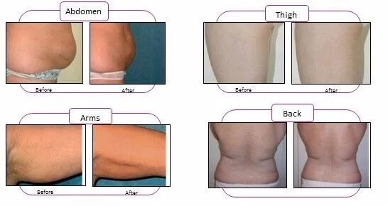 Professional CE Approved lipo laser slimming machine with 209mw lamp