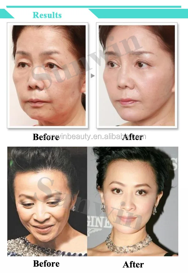 Hot selling portable Hifu Face and Body Machine, Wrinkle Removal mini Hifu lifting with 10000 shots