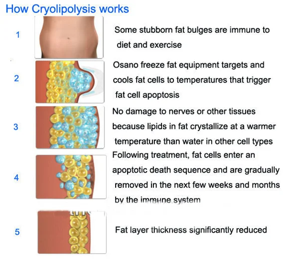 cryoliplysis adipose freezing / cryolipolysi slimming machine / criolipolisis for fat reduction beauty for body equipment