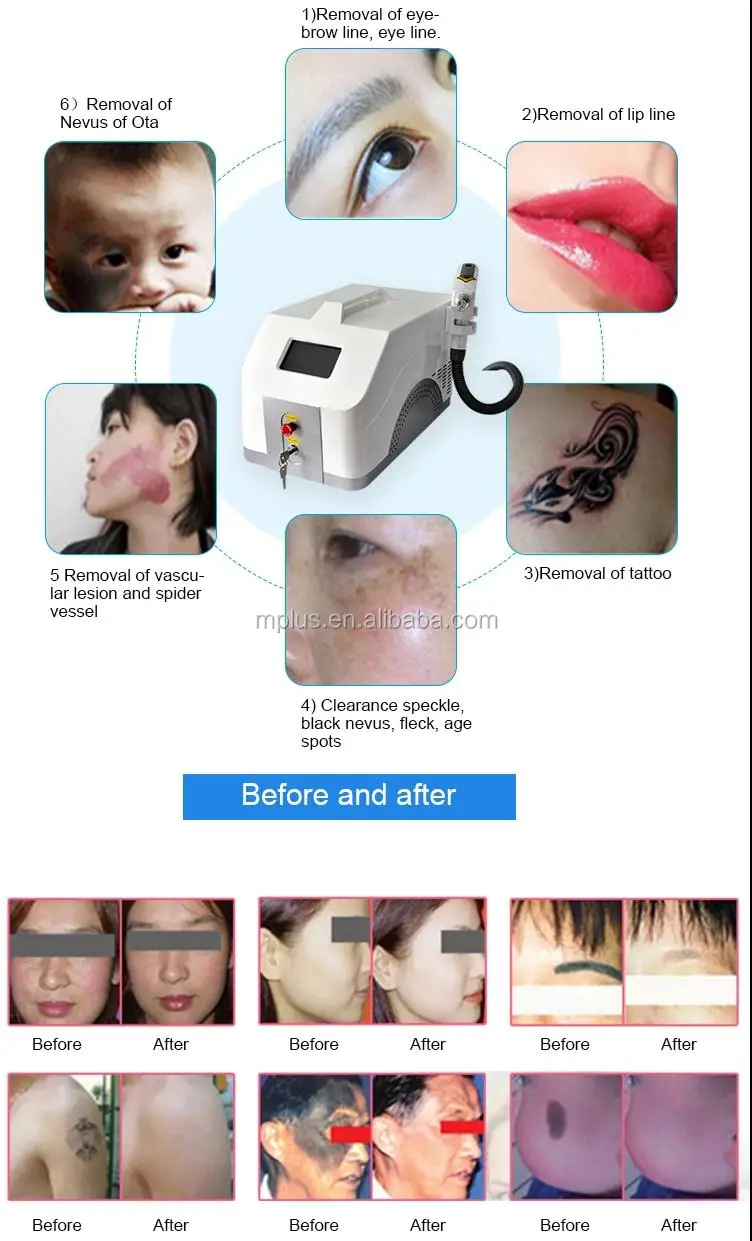 Professional portable skin rejuvenation nd yag q switch tattoo removal machine for salon