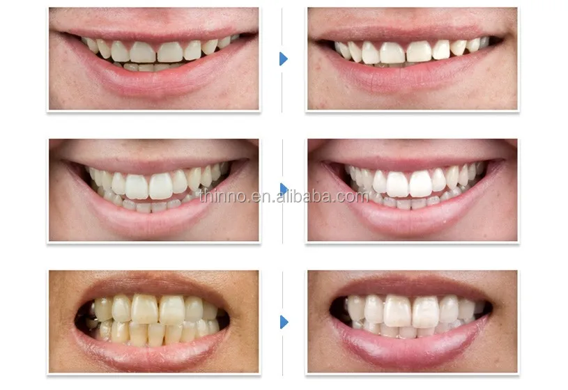 Отбеливание зубов лазером или zoom что лучше ирригатор для зубов нижний новгород
