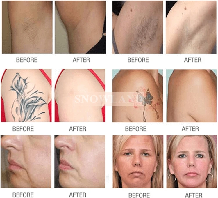 ipl laser hair removal machine for sale.jpg