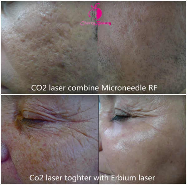 best laser for acne scars