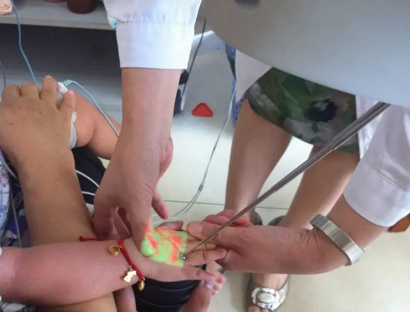 New Blood Vessel Illumination Set for Injection