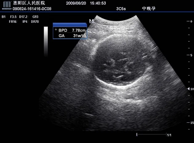 Portable 3D Doppler Ultrasound Machine Ultrasonography