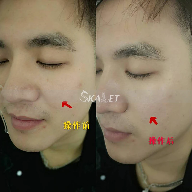 Professional Non-invasive Wrinkle Remover anti-bacterial with CE