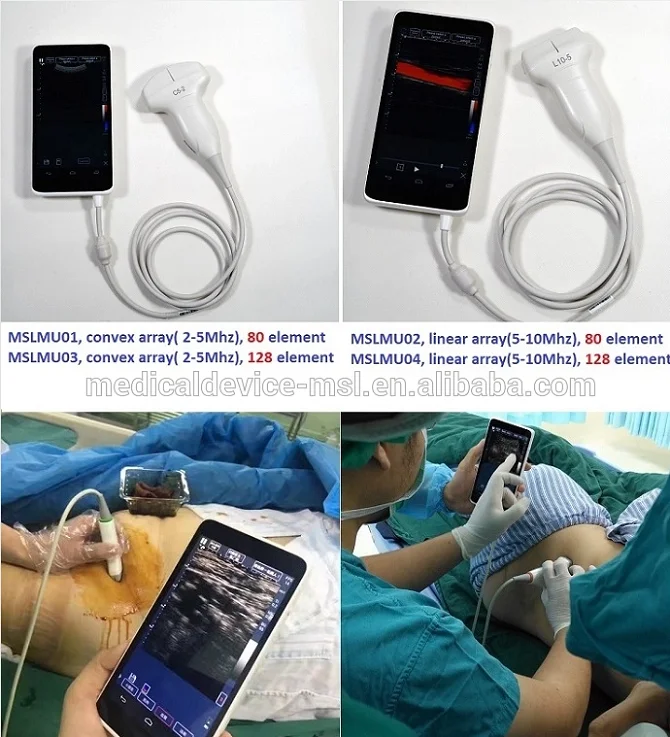 High Frequency 10mhz Linear Array Wifi Ultrasound,Multifrequency 5