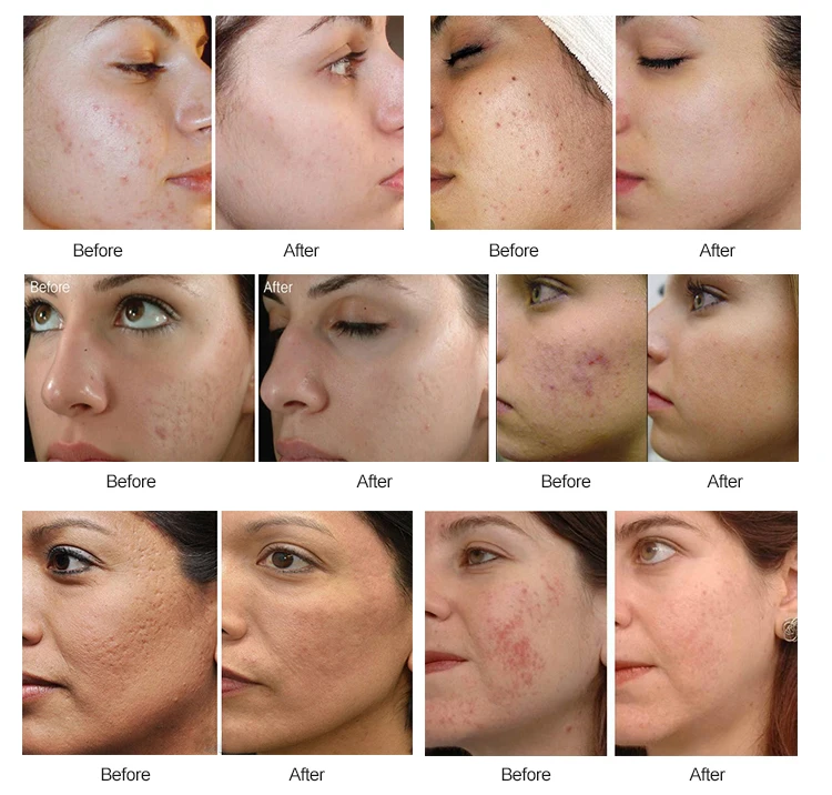 dermapen for dark circles