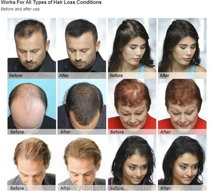 Bunee 2017 Hot Sale Hair Building Fibers For Baldness Treatment