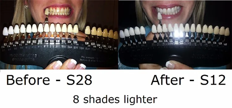 Denture Teeth Color Chart