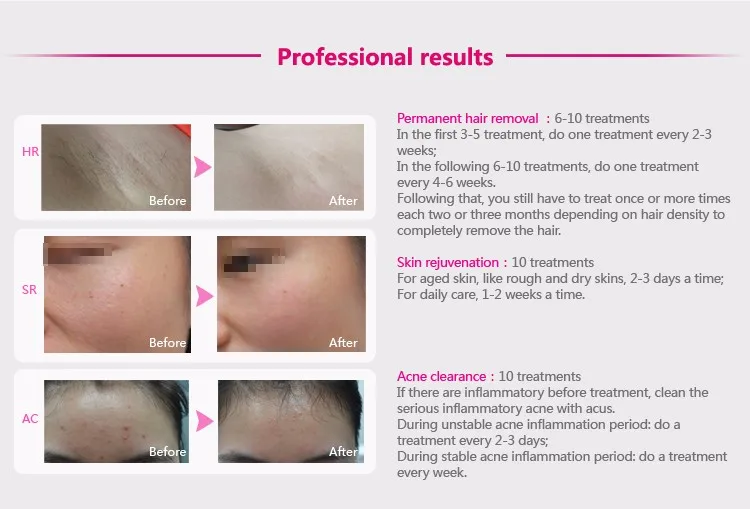  Permanent Hair Removal Device