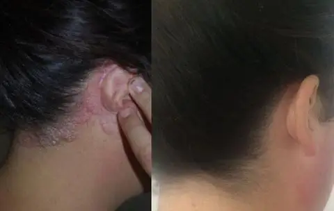 uv lamp vitiligo