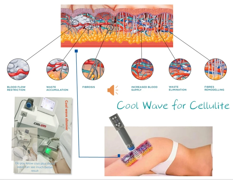 new idea coolwave electromagnetic shockwave ED therapy & cryolipolyisis vacuum fat freezing body slimming machine