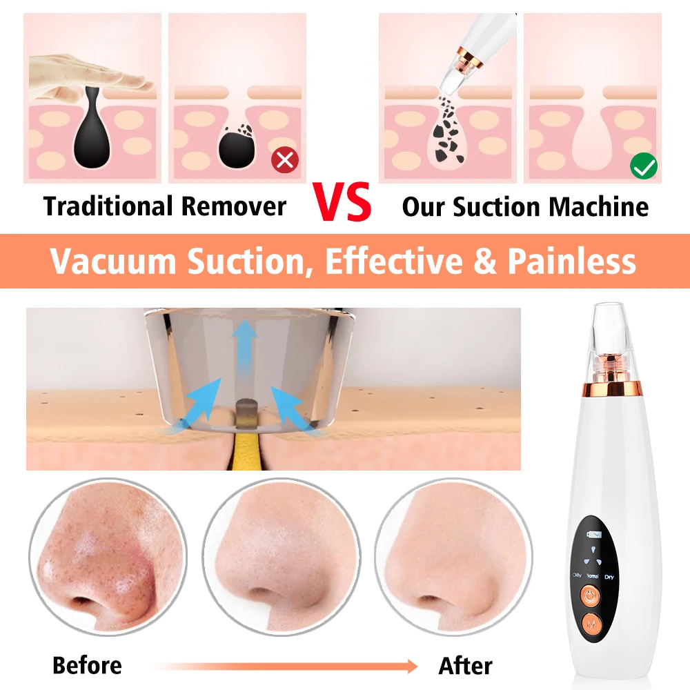 Electronic Professional Skin Face Deep Nose Pore Pore Cleaner Vaccum microdermabrasion Blackhead Suction Remover .jpg