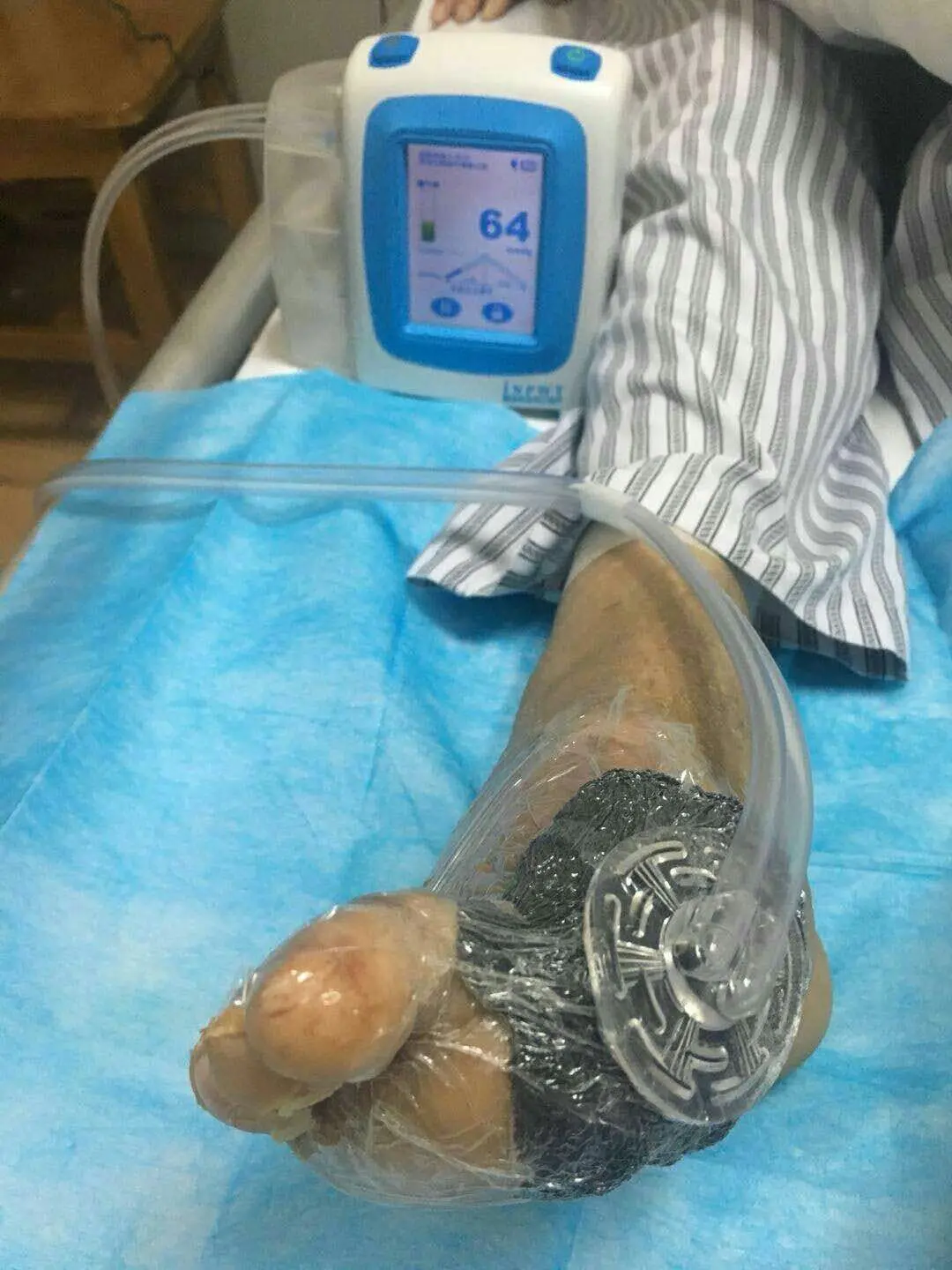 External Npwt (negative Pressure Wound Therapy) 140ml