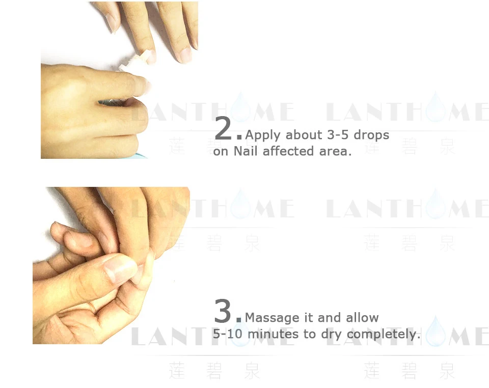 Lanthome Anti Fungus Infection Antibacterial Fungal Nail Treatment Feet