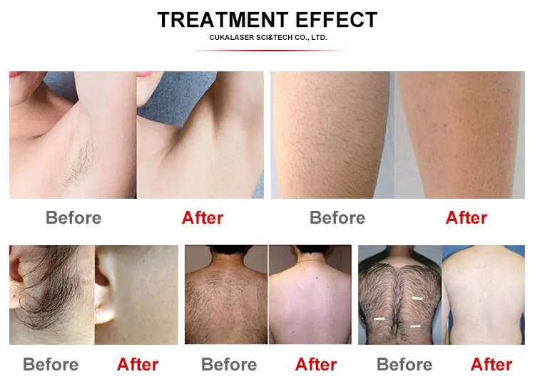 laser hair removal.jpg