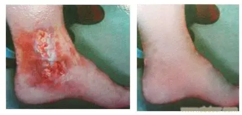 wound dressing 02.jpg