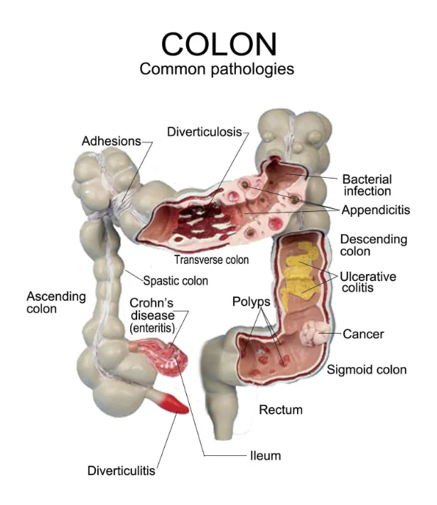 Large Intestine Rectum Pathology Medical Anatomical Model,Medical ...