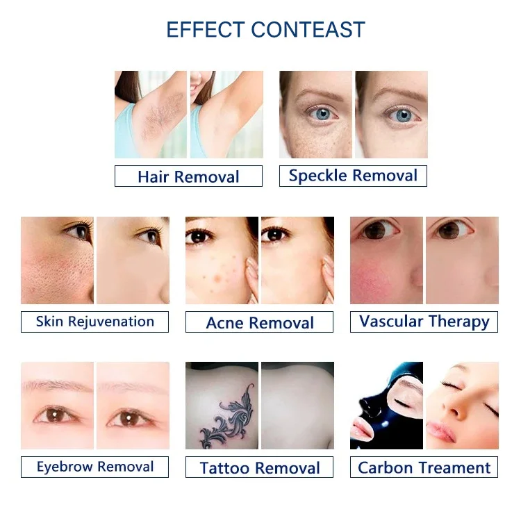 ipl hair removal-JS-06-8