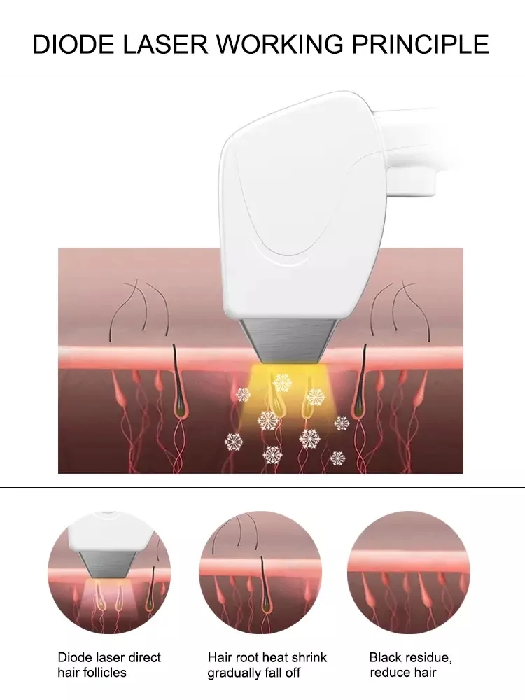 diode laser 755 808 1064 diode laser hair removal fast and painless profissional hair removal machine permanent