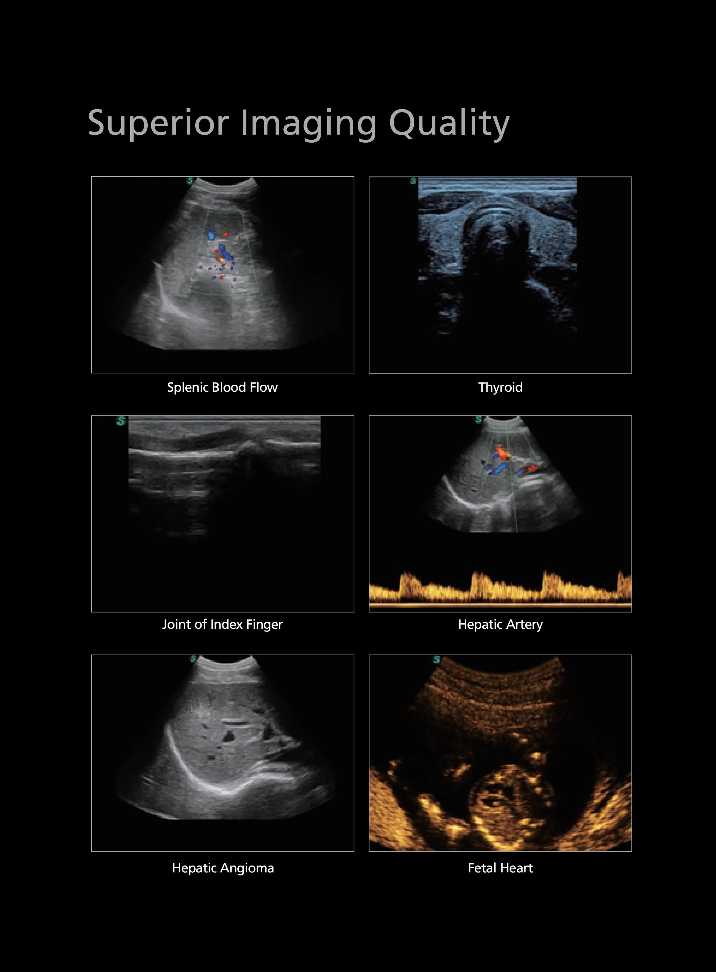 Sonoscape S11 Trolley Color Doppler Ultrasound system USG 15-inch High-Resolution Color LCD